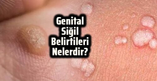 Genital Siğil | Gaziantep Escort Bayan Genital Siğil